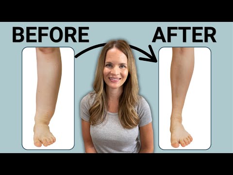 Expert Certified Lymphedema Therapist for Effective Treatment