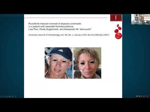 Concert Pharma CTP 543: Overview and Key Information