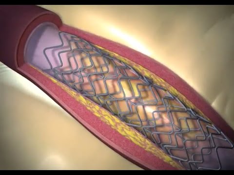 DAPT Trial Summary: Key Findings and Implications