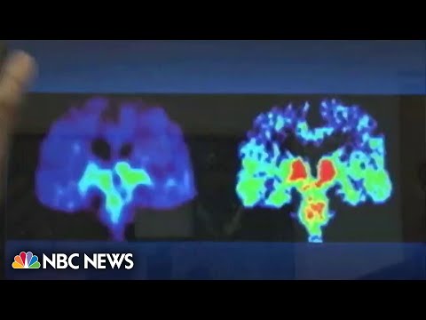 DCVAX Glioblastoma: Treatment and Research Updates